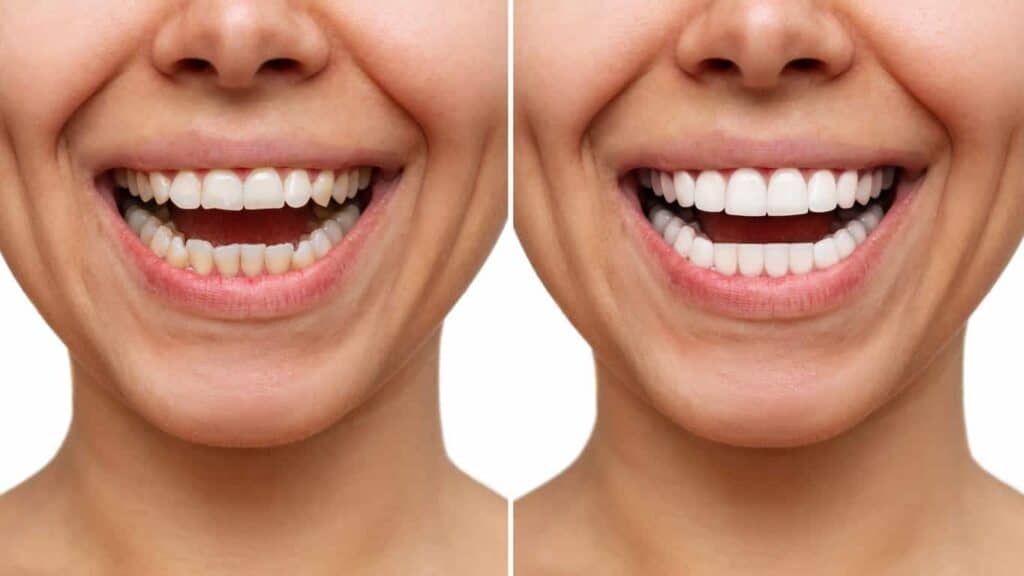 Contact Aspire White for teeth whitening services – Get in touch with Middlesbrough today