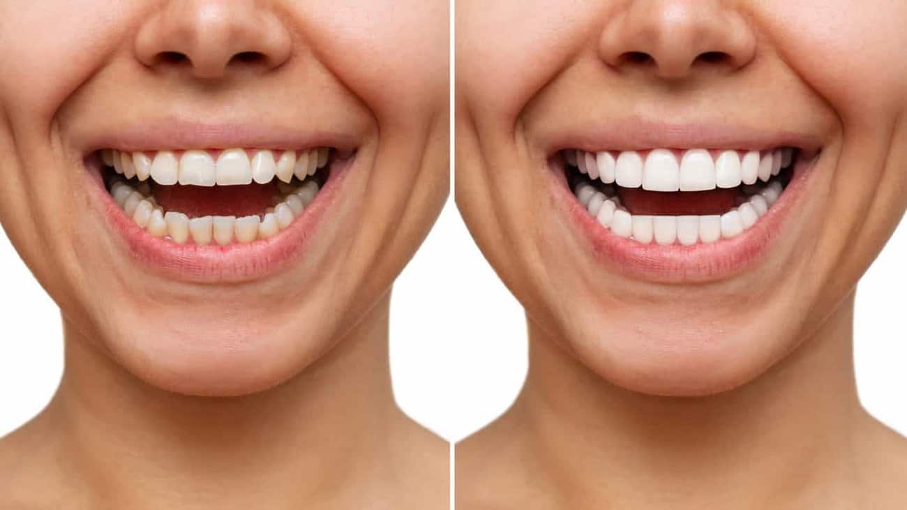 Contact Aspire White for teeth whitening services – Get in touch with Middlesbrough today