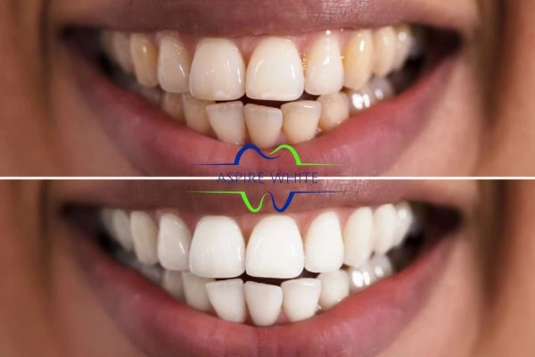 Aspire White customer before and after Middlesbrough results.