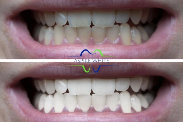 1 hour laser teeth whitening before and after results Middlesbrough