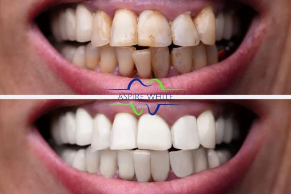 Before and after results of laser teeth whitening Middlesbrough Book in online today!